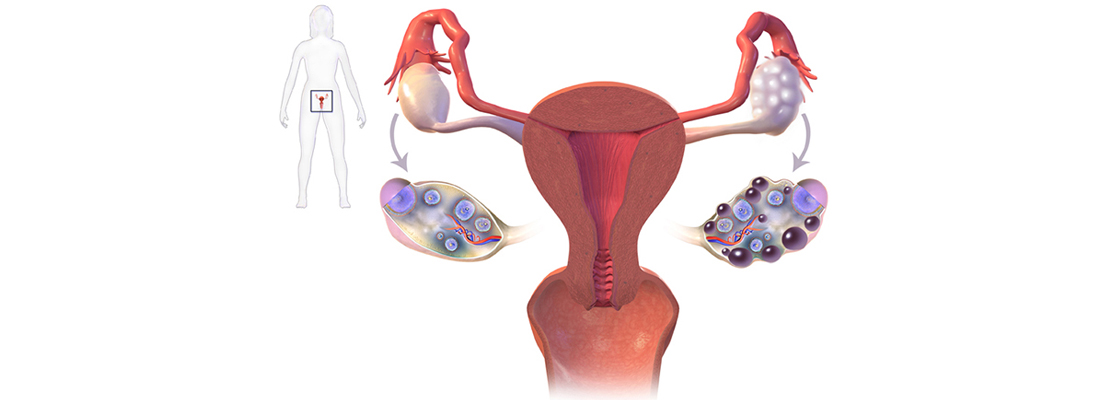چگونه با تخمدان پلی کیستیک باردار شویم