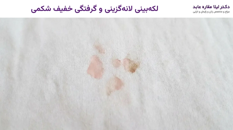 لکه بینی لاله گزینی و گرفتگی خفیف شکمی