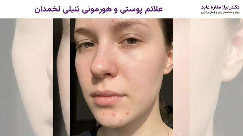 علائم پوستی و هورمونی تنبلی تخمدان