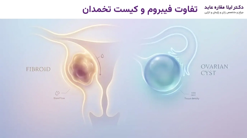 تفاوت فیبروم و کیست تخمدان