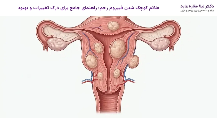 علائم کوچک شدن فیبروم رحم: راهنمای جامع برای درک تغییرات و بهبود