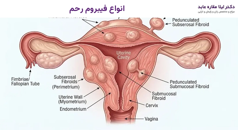 انواع فیبروم رحم