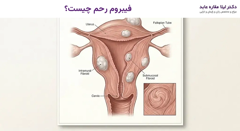 فیبروم رحم چیست؟