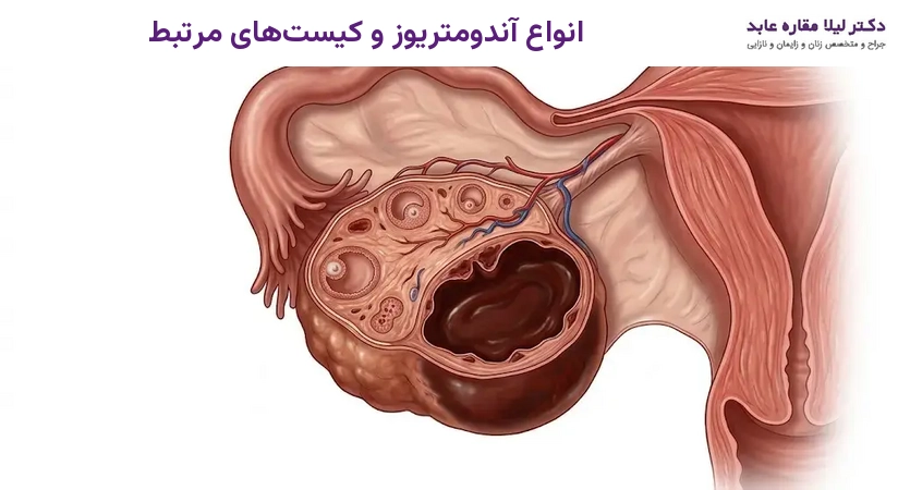 انواع آندومتریوز و کیست‌های مرتبط