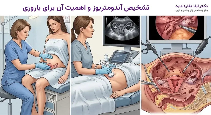 تشخیص آندومتریوز و اهمیت آن برای باروری