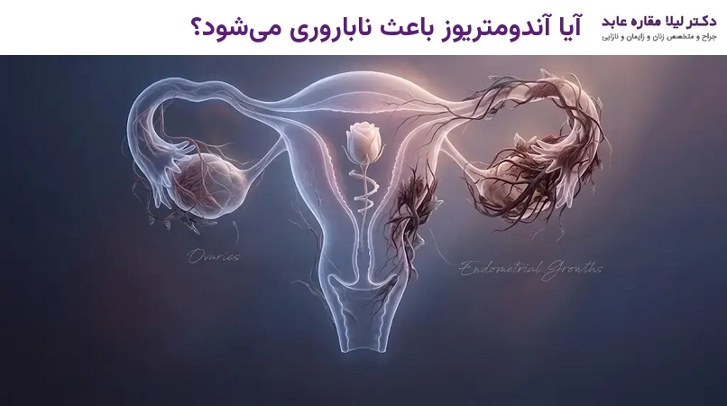 آیا آندومتریوز باعث ناباروری می‌شود؟