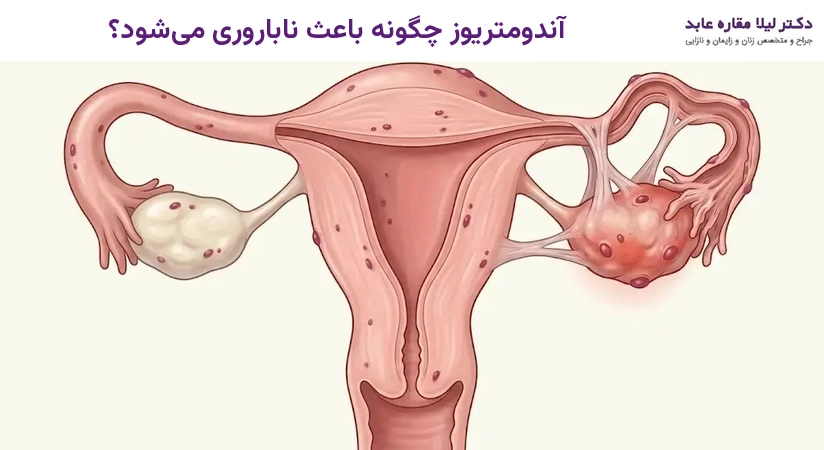 آندومتریوز چگونه باعث ناباروری می‌شود؟