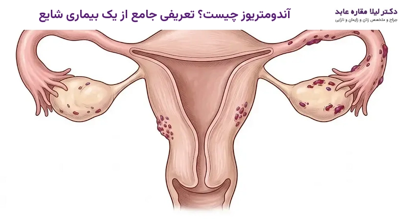 آندومتریوز چیست؟ تعریفی جامع از یک بیماری شایع