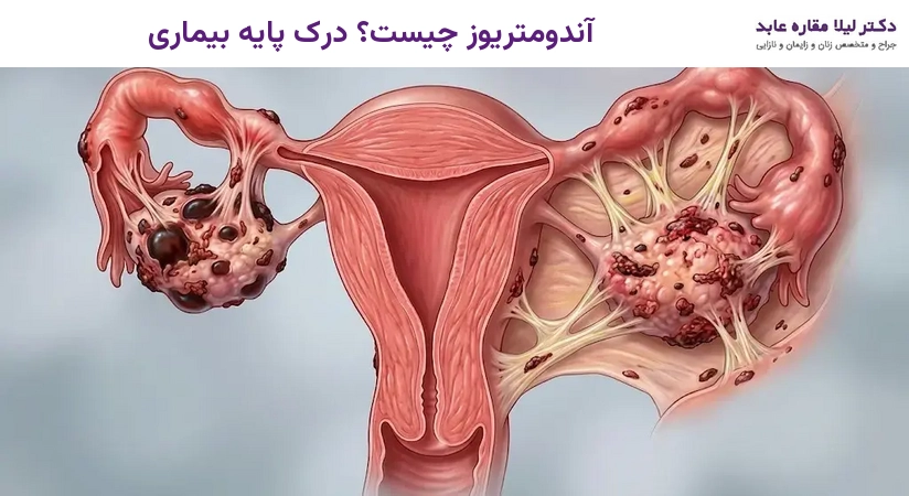 آندومتریوز چیست؟ درک پایه بیماری