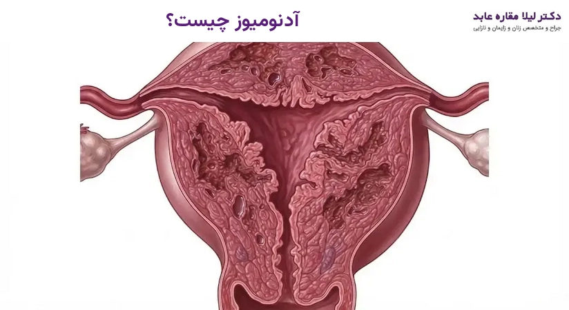 آدنومیوز چیست؟