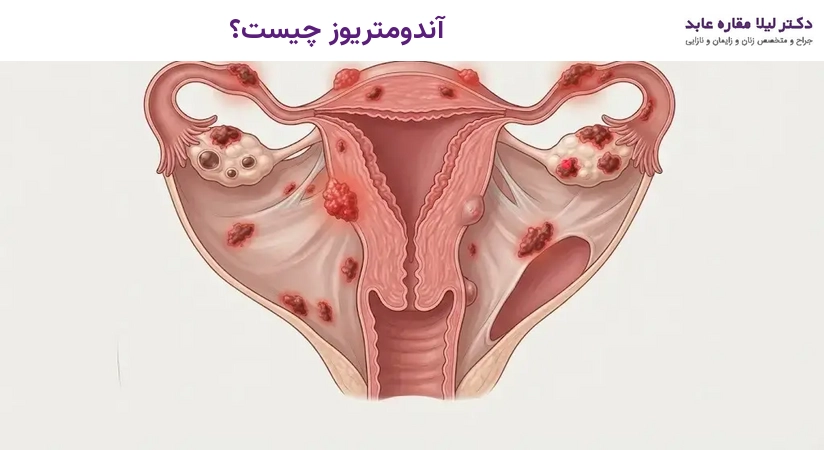 آندومتریوز چیست؟