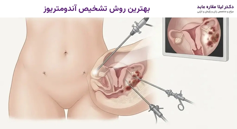 بهترین روش تشخیص آندومتریوز