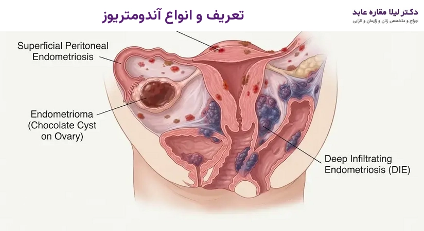 تعریف و انواع آندومتریوز