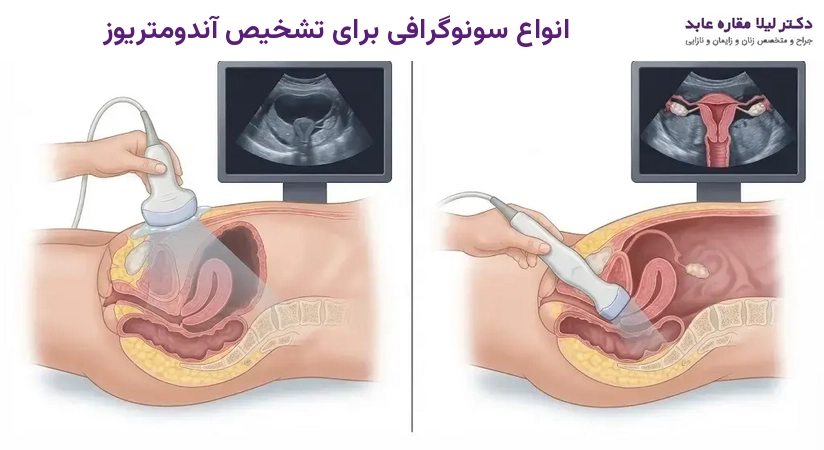 انواع سونوگرافی برای تشخیص آندومتریوز