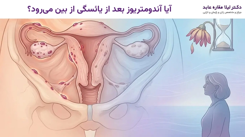 آیا آندومتریوز بعد از یائسگی از بین می‌رود؟