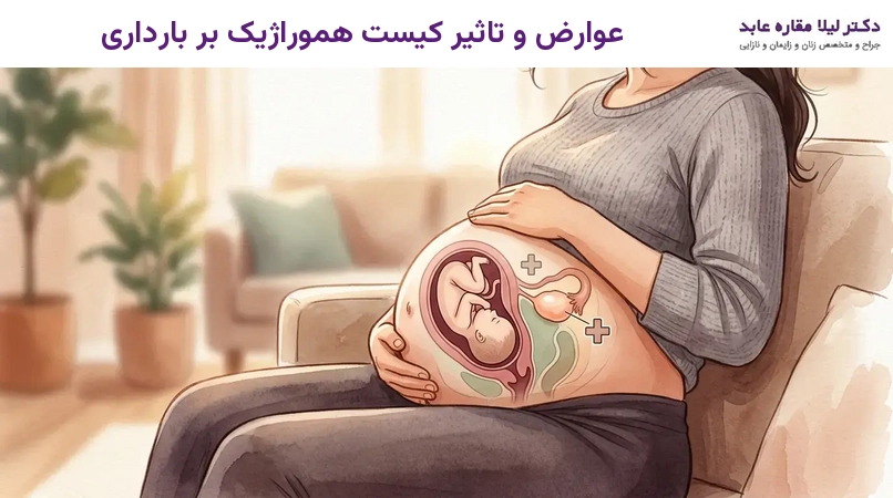 عوارض و تاثیر کیست هموراژیک بر بارداری