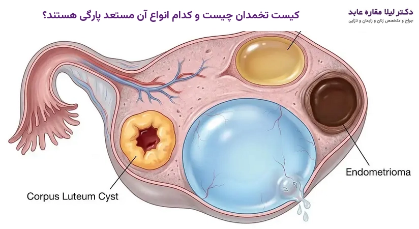 کیست تخمدان چیست و کدام انواع آن مستعد پارگی هستند؟