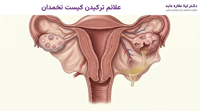 علائم ترکیدن کیست تخمدان