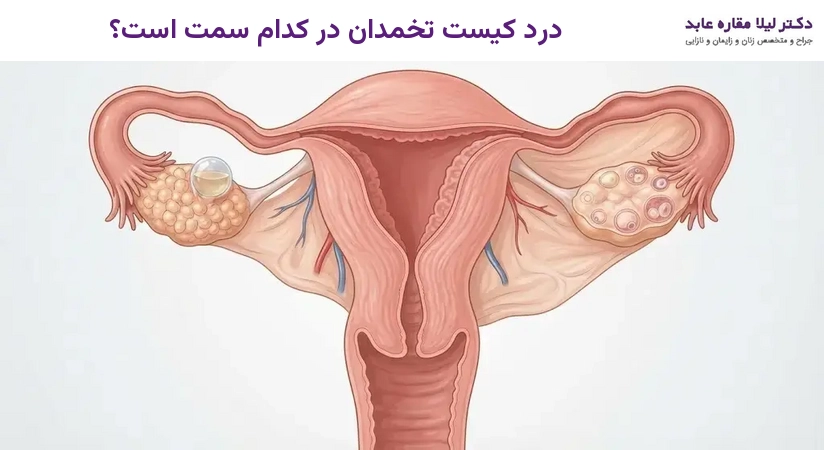 درد کیست تخمدان در کدام سمت است؟