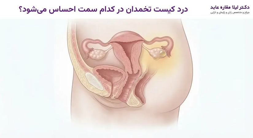 درد کیست تخمدان در کدام سمت است؟