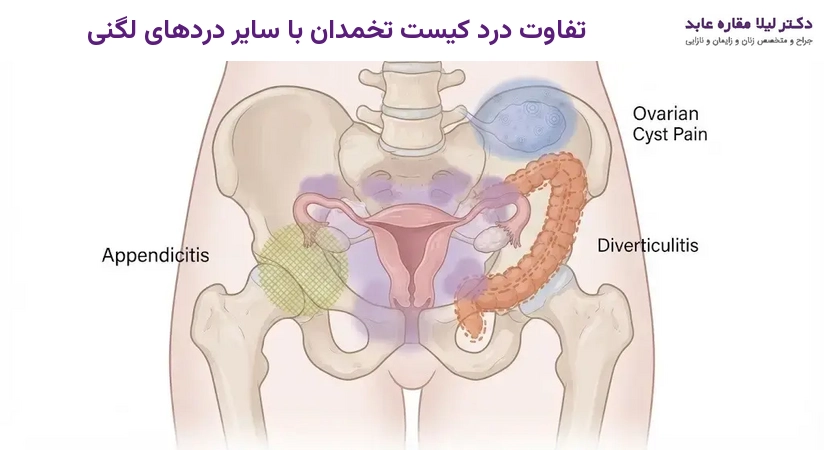 تفاوت درد کیست تخمدان با سایر دردهای لگنی