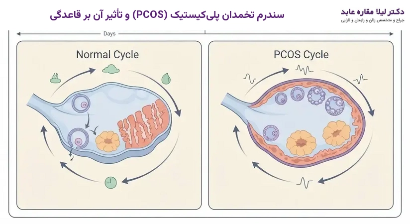 سندرم تخمدان پلی‌کیستیک (PCOS) و تأثیر آن بر قاعدگی