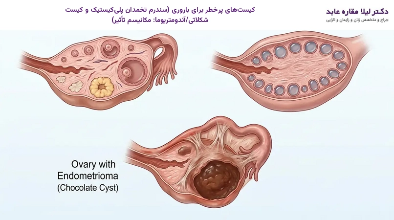 کیست‌های پرخطر برای باروری (سندرم تخمدان پلی‌کیستیک و کیست شکلاتی/آندومتریوما: مکانیسم تأثیر)