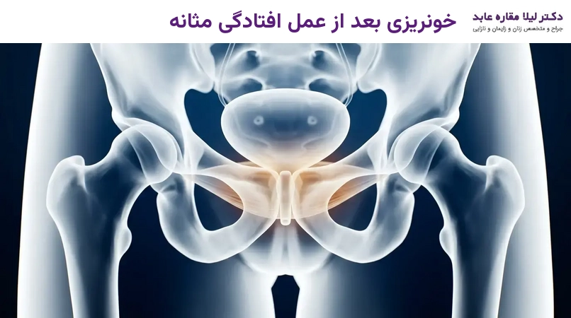 خونریزی بعد از عمل افتادگی مثانه