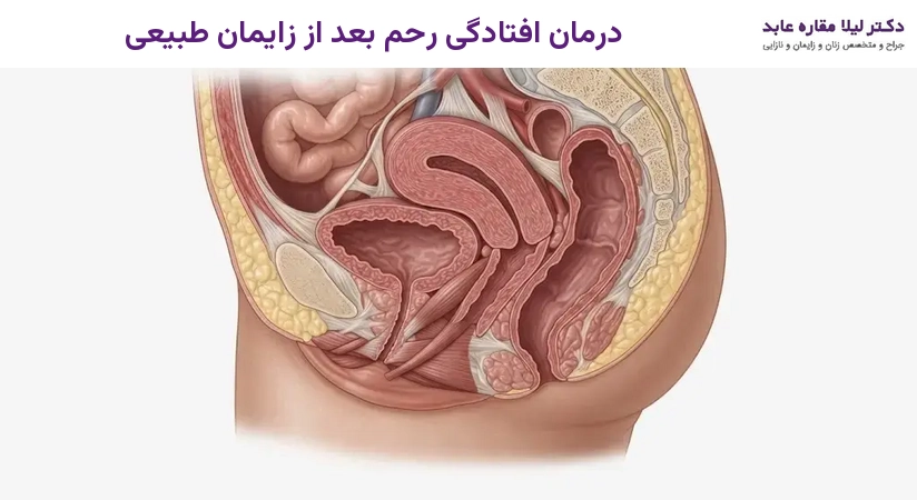 درمان افتادگی رحم بعد از زایمان طبیعی