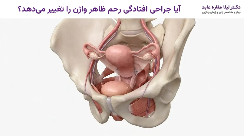 آیا جراحی افتادگی رحم ظاهر واژن را تغییر می‌دهد؟