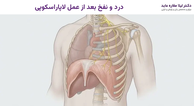 درد و نفخ بعد از عمل لاپاراسکوپی