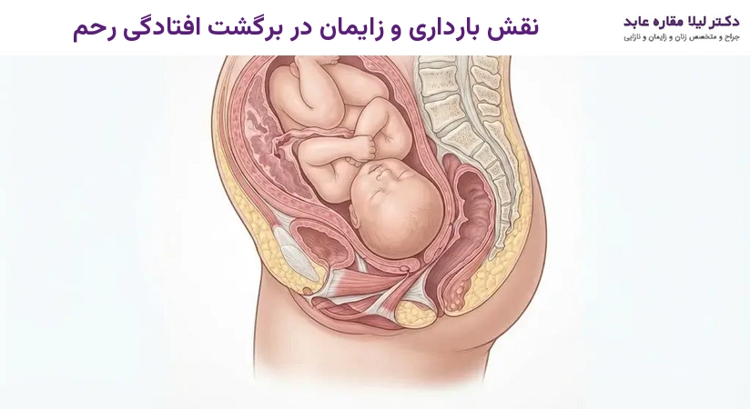 نقش بارداری و زایمان در برگشت افتادگی رحم