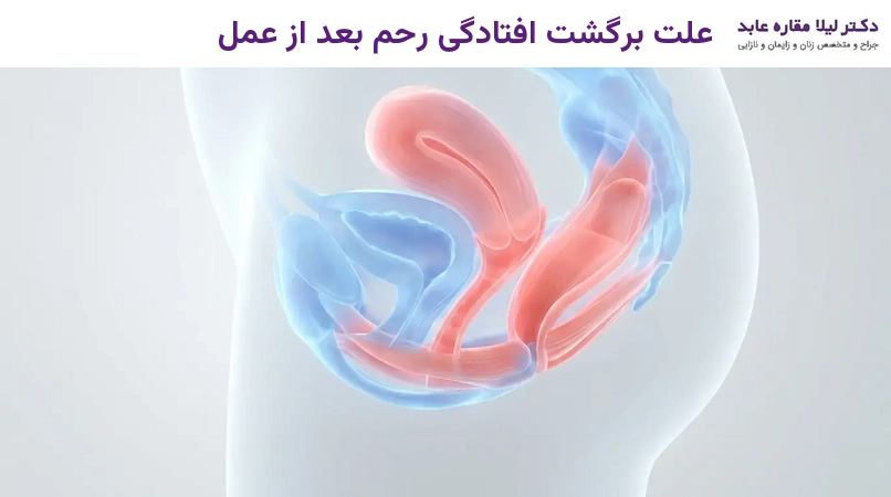 علت برگشت افتادگی رحم بعد از عمل