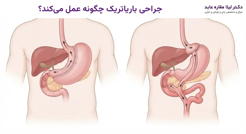 جراحی باریاتریک چگونه عمل می‌کند؟