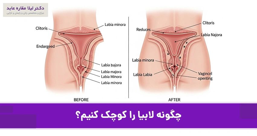 چگونه لابیا را کوچک کنیم