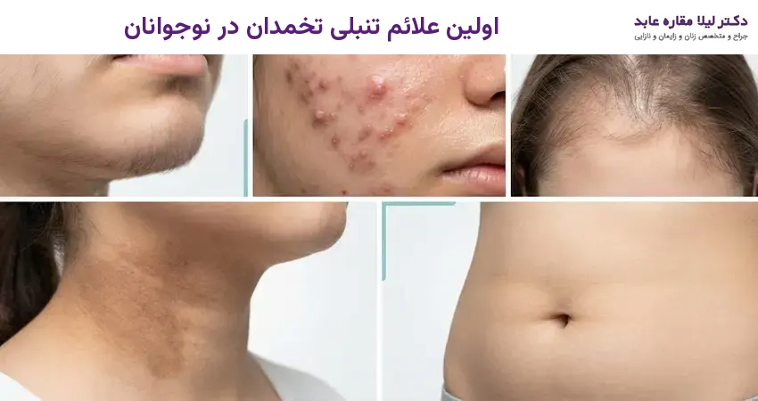 اولین علائم تنبلی تخمدان در نوجوانان