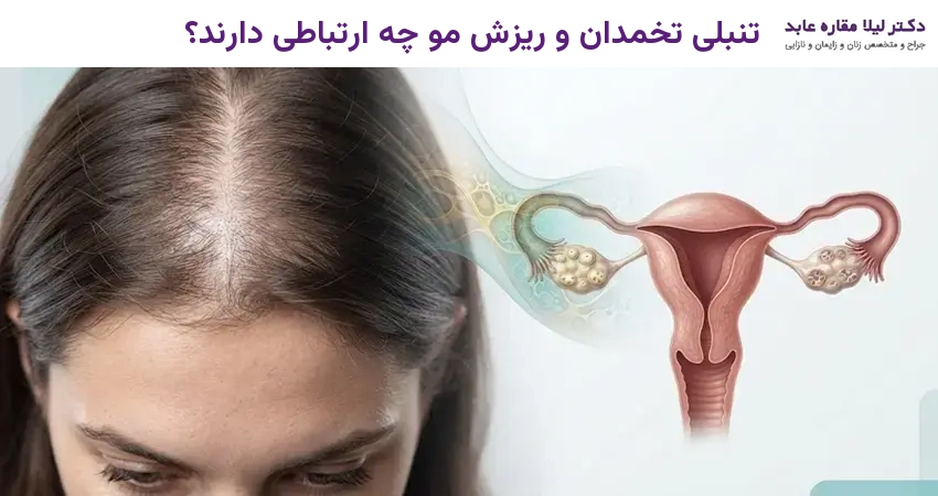 تنبلی تخمدان و ریزش مو چه ارتباطی دارند؟