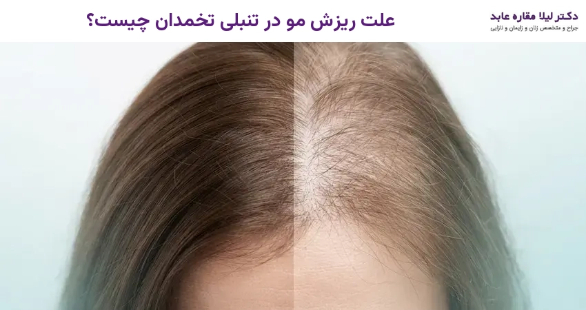 علت ریزش مو در تنبلی تخمدان چیست؟