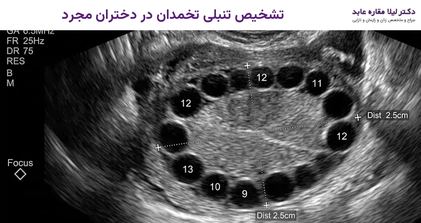 تشخیص تنبلی تخمدان در دختران مجرد