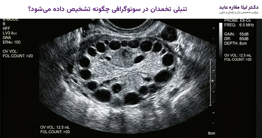 تنبلی تخمدان در سونوگرافی چگونه تشخیص داده میشود؟
