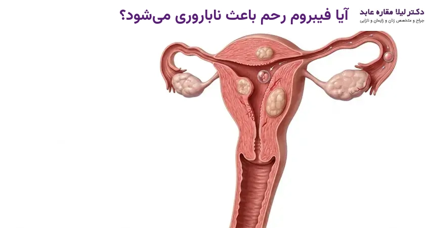 آیا فیبروم رحم باعث ناباروری می‌شود؟