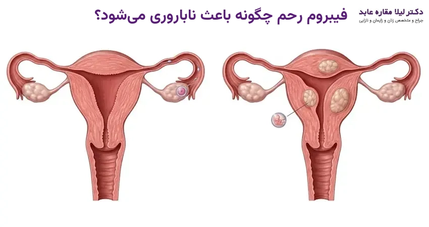 فیبروم رحم چگونه باعث ناباروری می شود؟