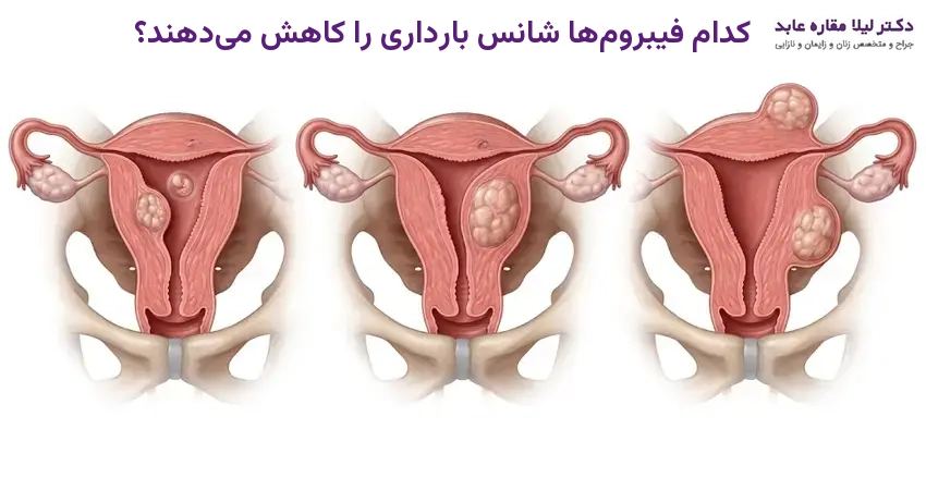 کدام فیبروم ها شانس بارداری را کاهش می دهند؟
