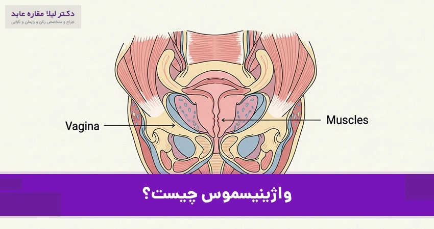 واژینیسموس چیست