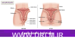 چگونه لابیا را کوچک کنیم