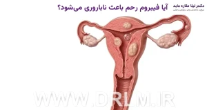 آیا فیبروم رحم باعث ناباروری می‌شود؟