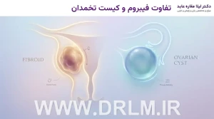 تفاوت فیبروم و کیست تخمدان
