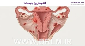 آندومتریوز چیست؟