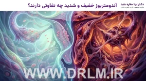 آندومتریوز خفیف و شدید چه تفاوتی دارند؟