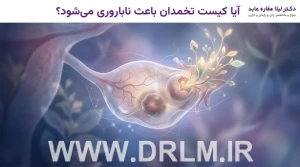 آیا کیست تخمدان باعث ناباروری می‌شود؟